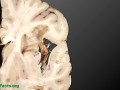 Avoiding epilepsy through diet