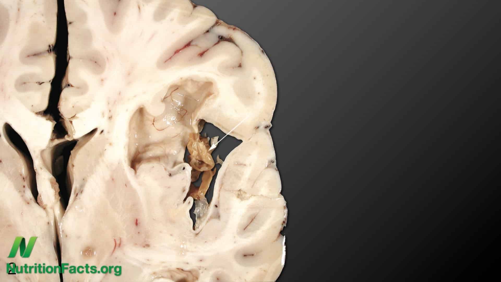 Avoiding epilepsy through diet