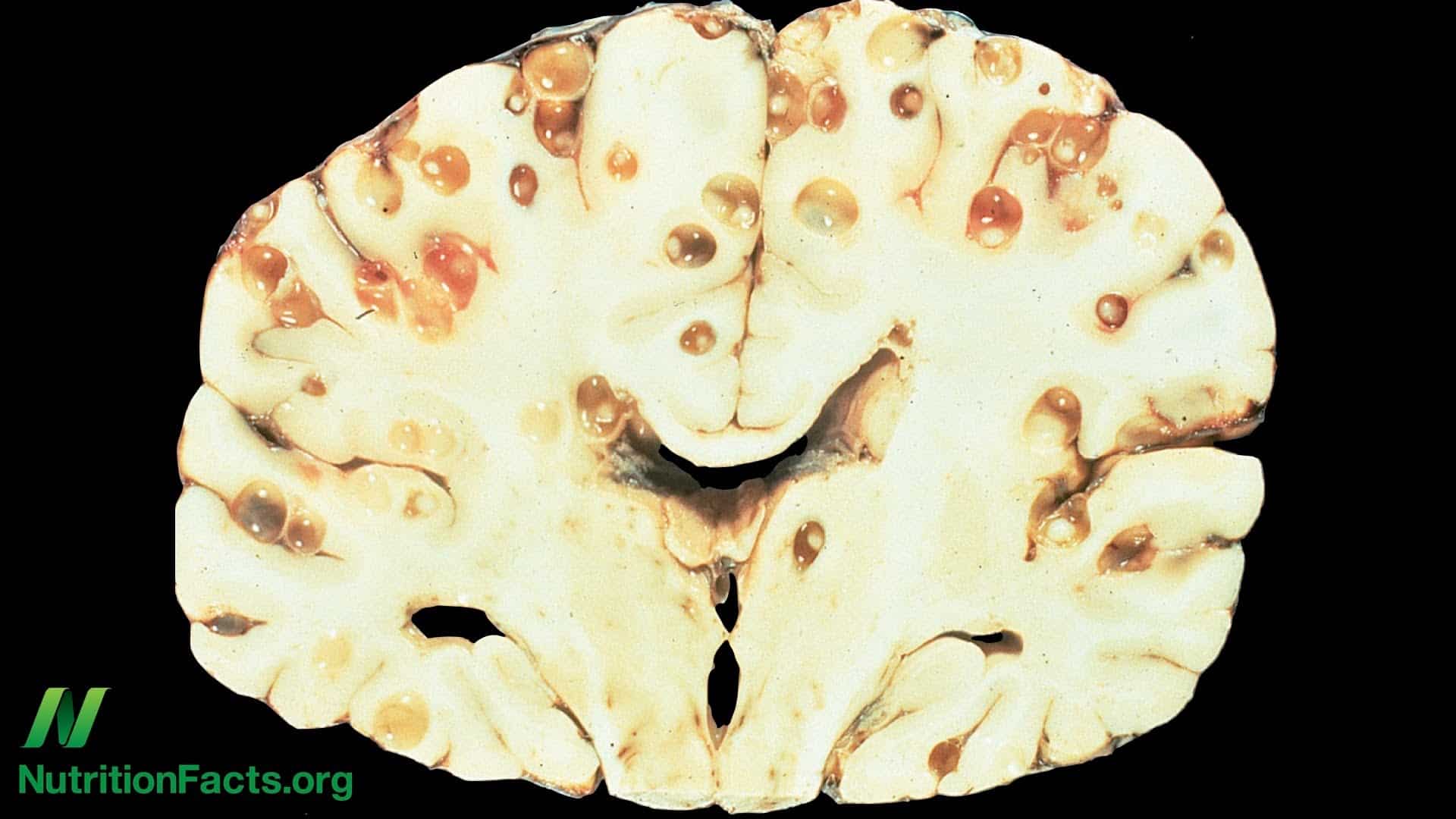 Pork tapeworms on the brain