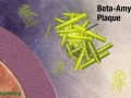 illustration of beta-amyloid plaque