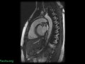 Abdominal aortic aneurysms- ticking time balloons