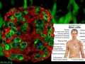 Broccoli Versus Breast Cancer Stem Cells