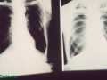 Preventing COPD with Diet
