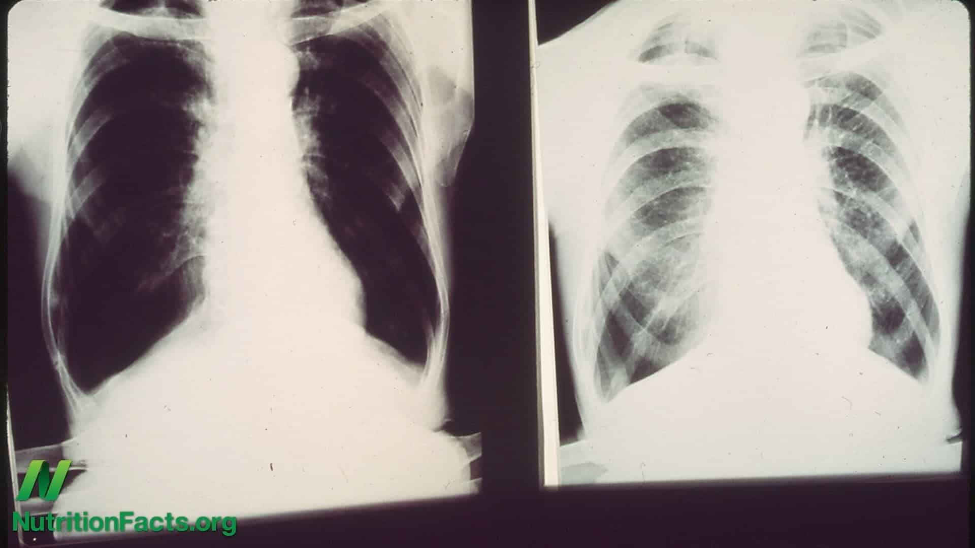 Preventing COPD with Diet