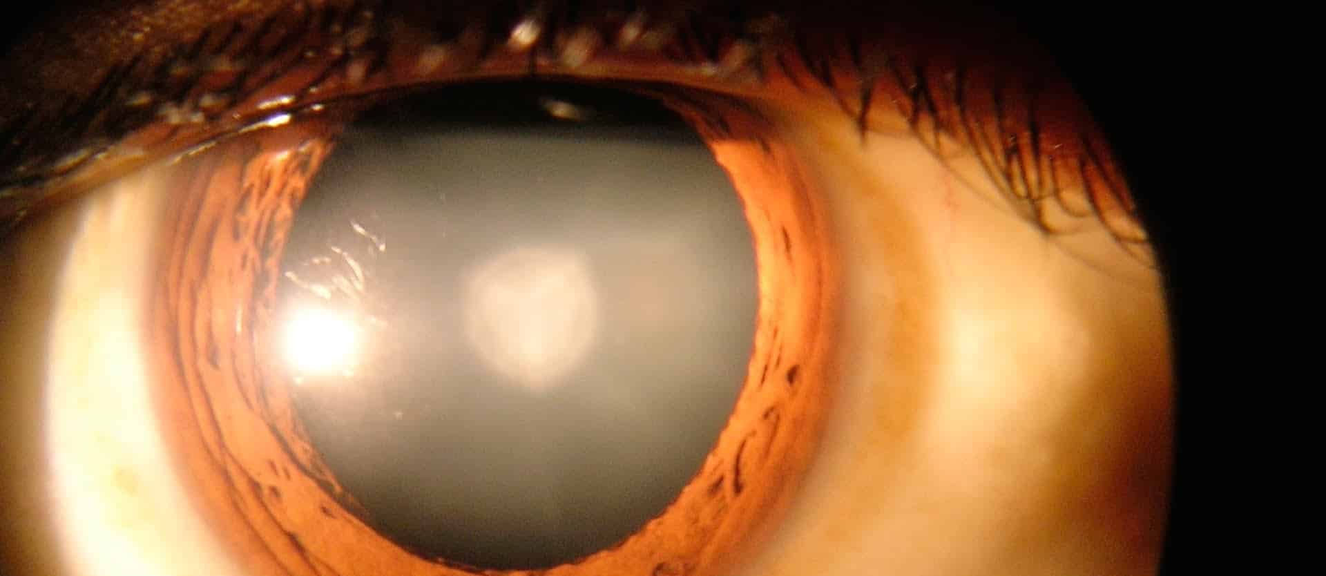 Preventing Cataracts with Diet