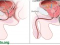 Prostate vs. plants