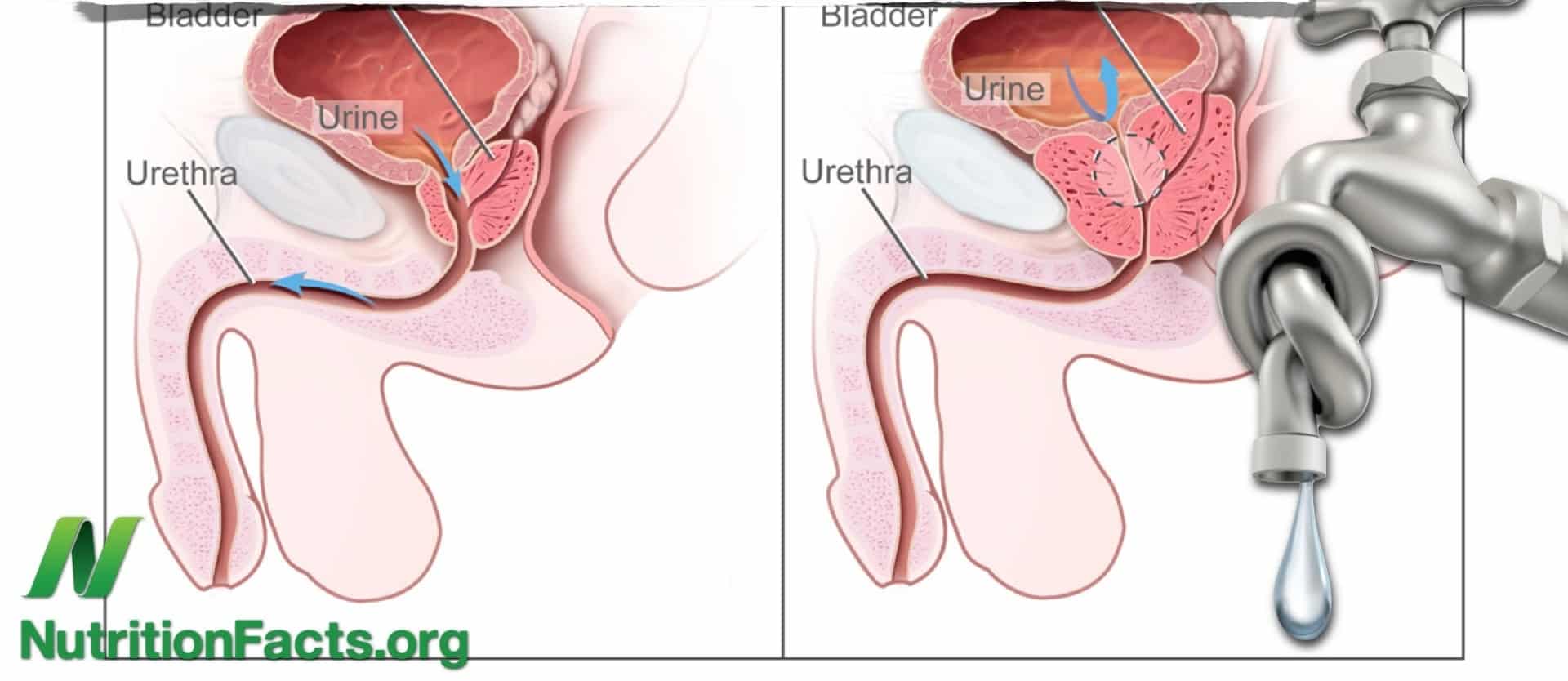 Prostate vs. plants