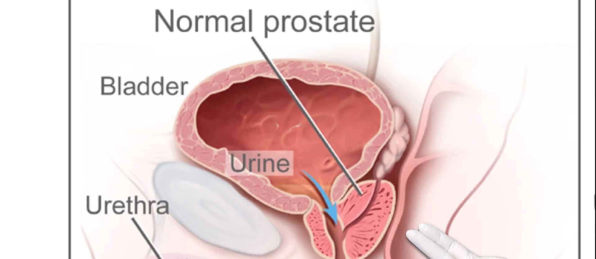 Some prostates are larger than others