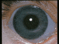 Glaucoma