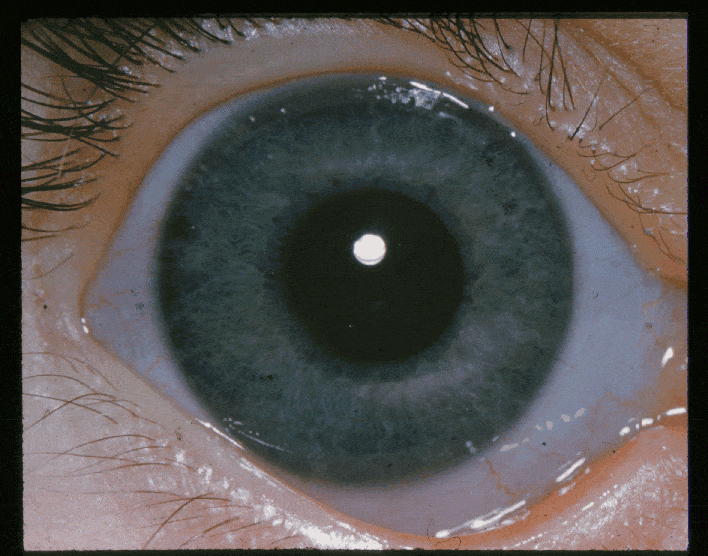 Glaucoma