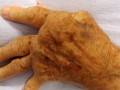 the hand of a person with arthritis