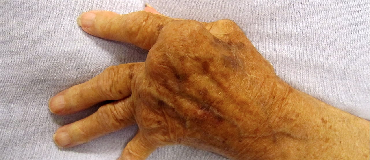 the hand of a person with arthritis