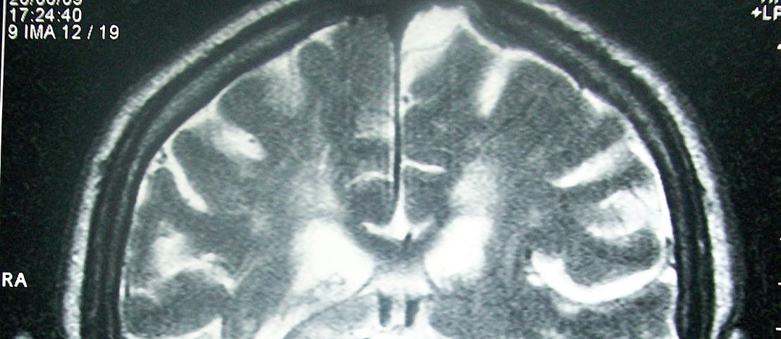 x-ray of a brain