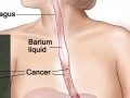 diagram of cancer in the esophagus