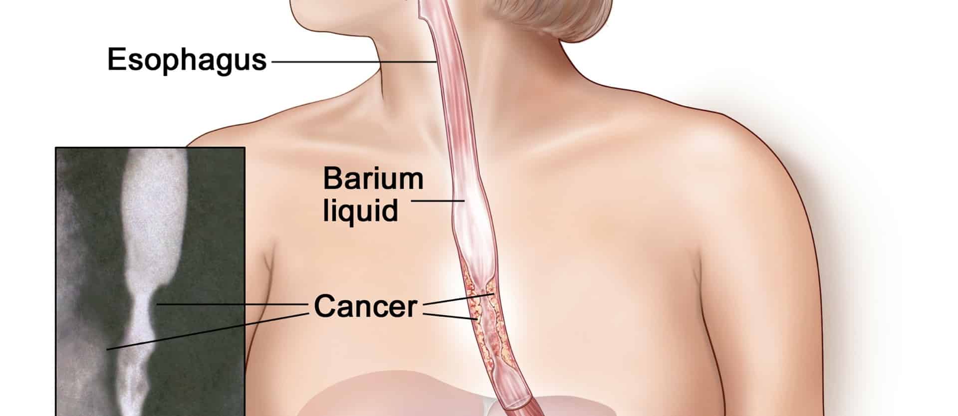 diagram of cancer in the esophagus