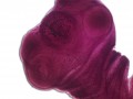 Chronic Headaches and Pork Tapeworms