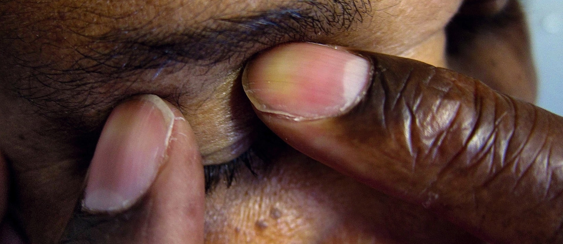 Greens vs. Glaucoma
