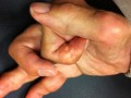 Turmeric Curcumin and Osteoarthritis