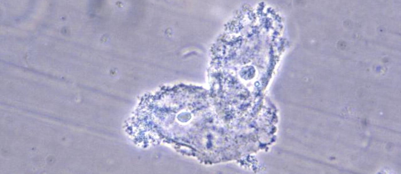 Preventing Bacterial Vaginosis With Diet