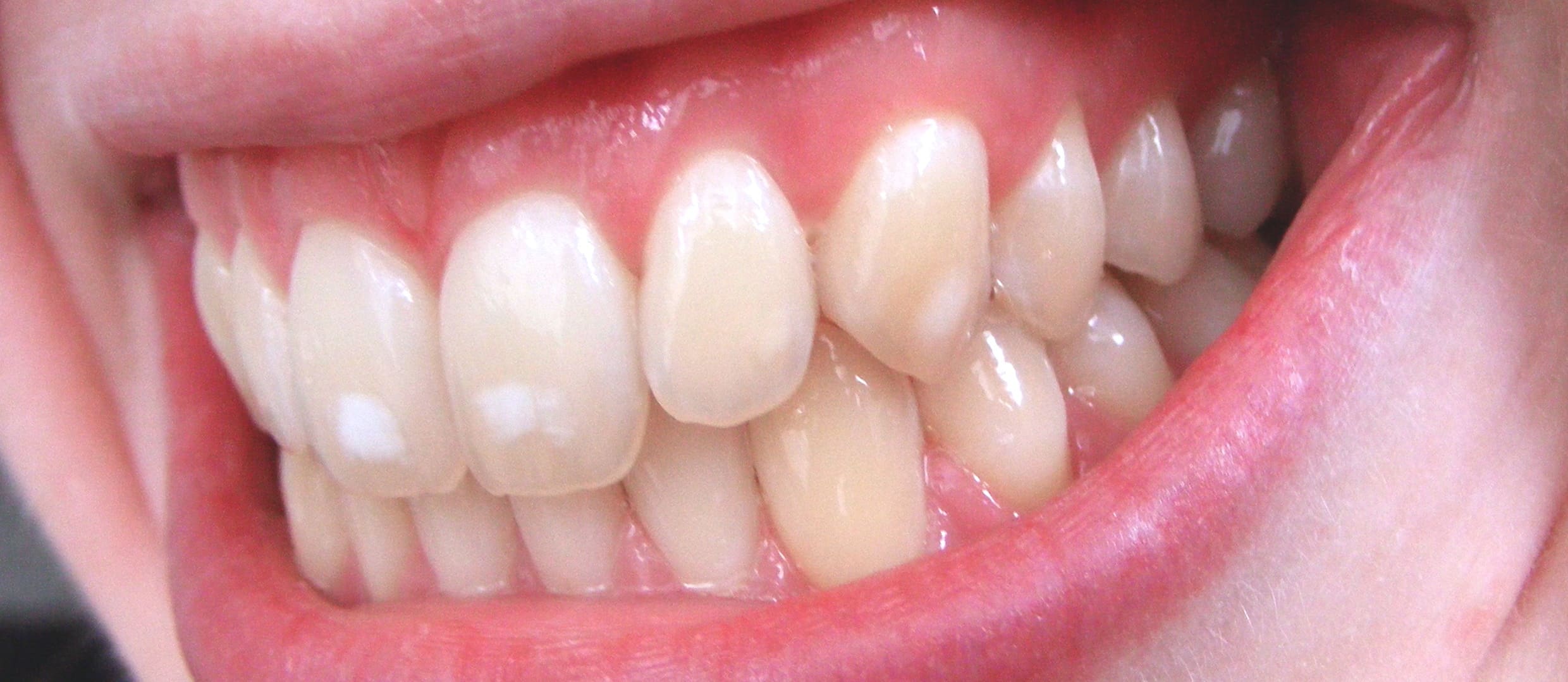 Childhood Tea Drinking May Increase Fluorosis Risk