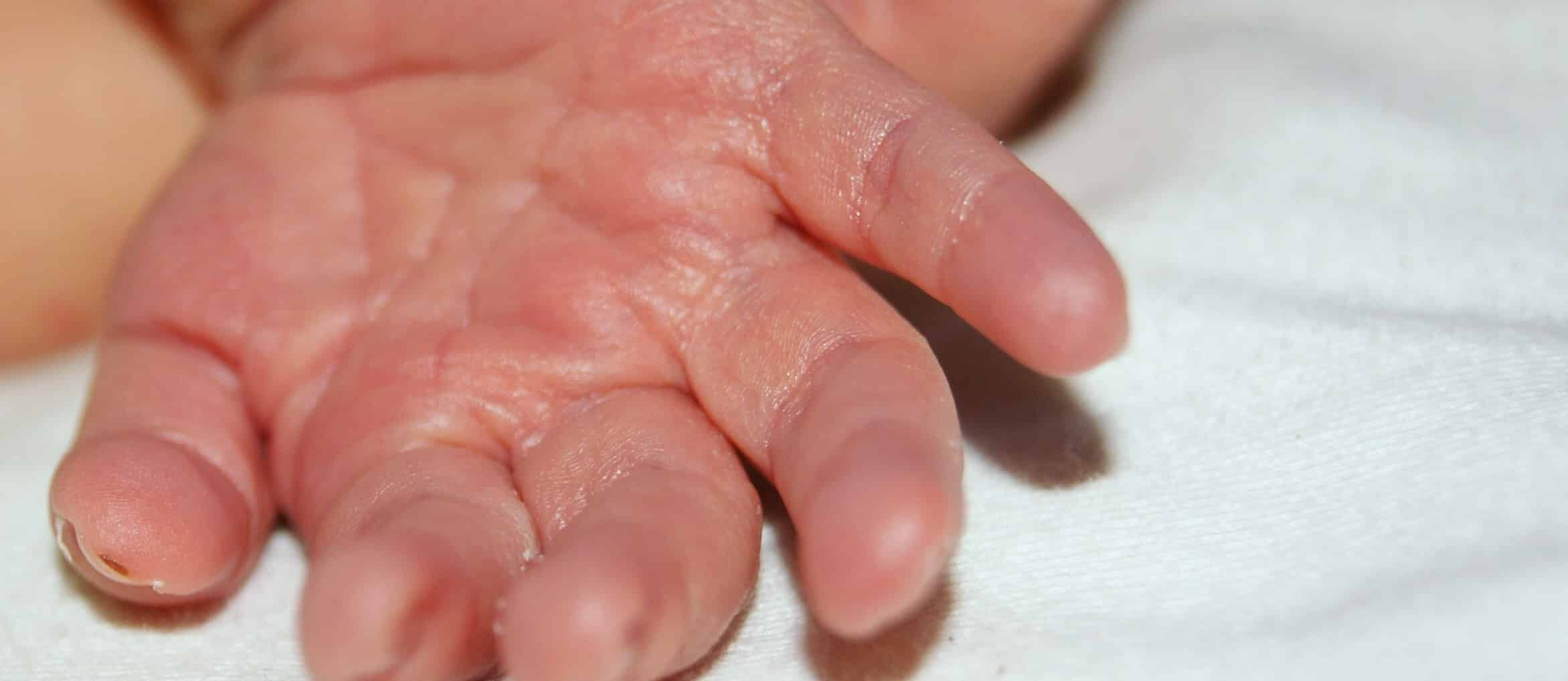 Infant Seizures Linked to Mother's Spirulina Use