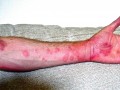 Tick Bites, Meat Allergies, and Chronic Urticaria