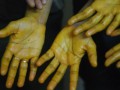 Topical Application of Turmeric Curcumin for Cancer