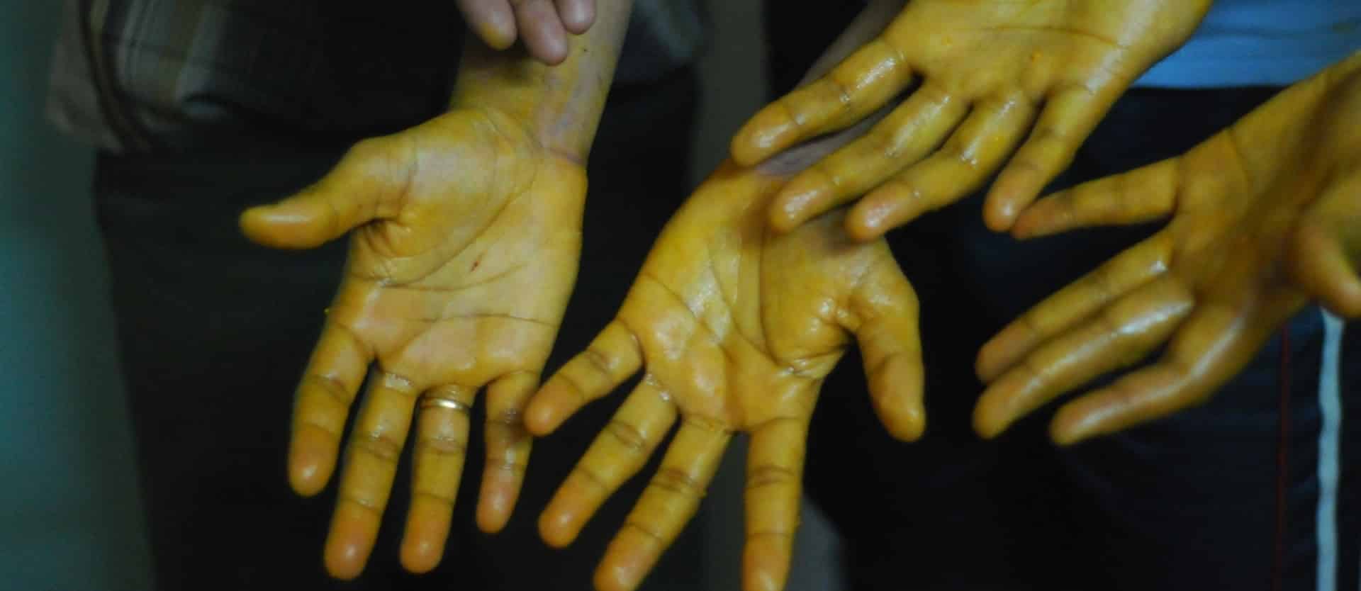 Topical Application of Turmeric Curcumin for Cancer