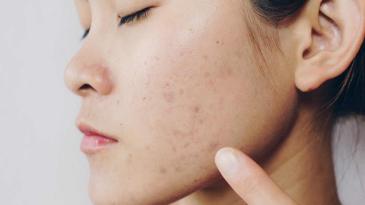 side profile of a person with spotted skin