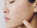 side profile of a person with spotted skin