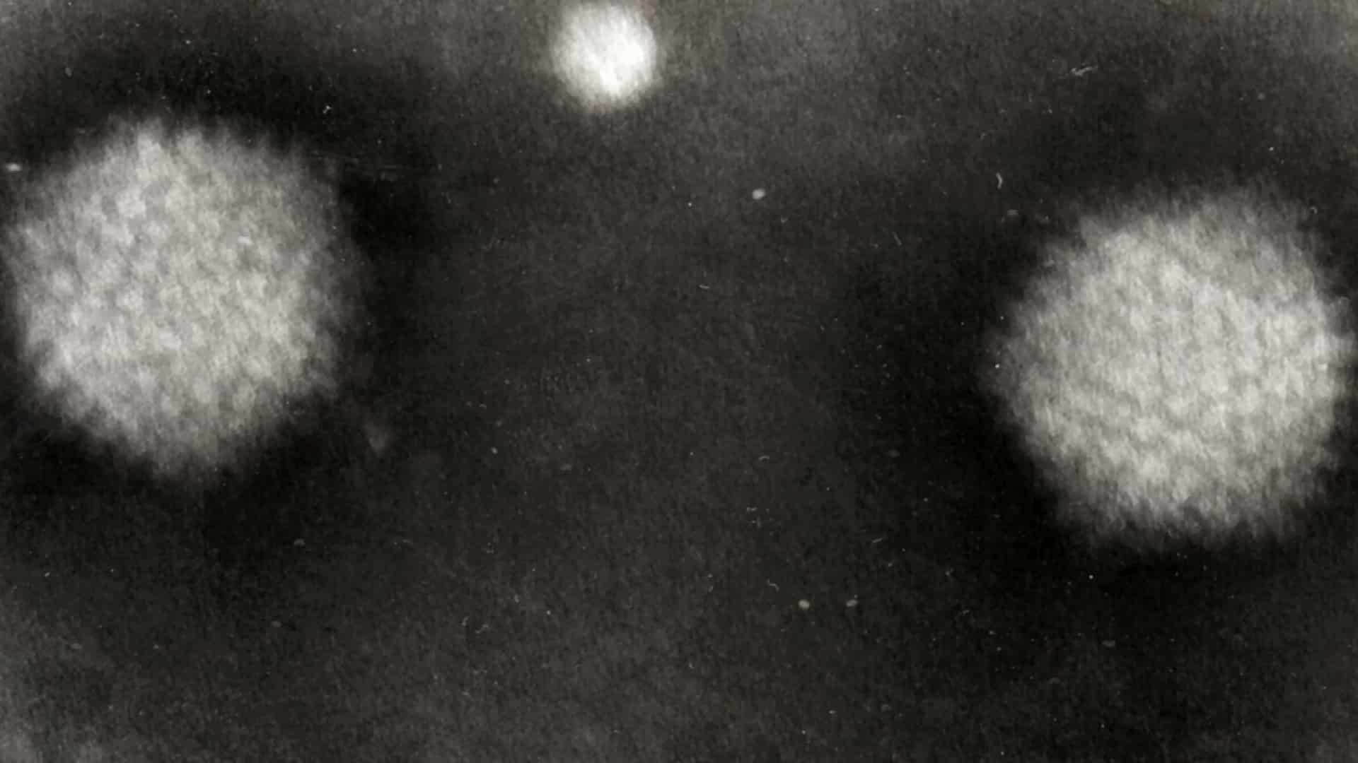 Infectobesity: Adenovirus 36 and Childhood Obesity