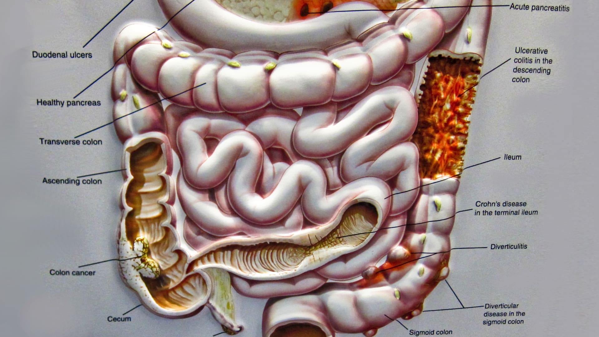 Preventing Crohn’s Disease With Diet
