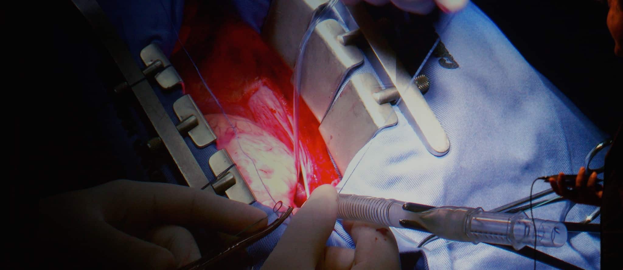 Fully Consensual Heart Disease Treatment