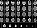 Preventing Brain Loss with B Vitamins?