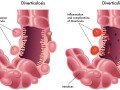 Diverticulosis: Cuando nuestro trastorno intestinal más común apenas existía
