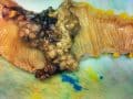cancerous tumor on a colon