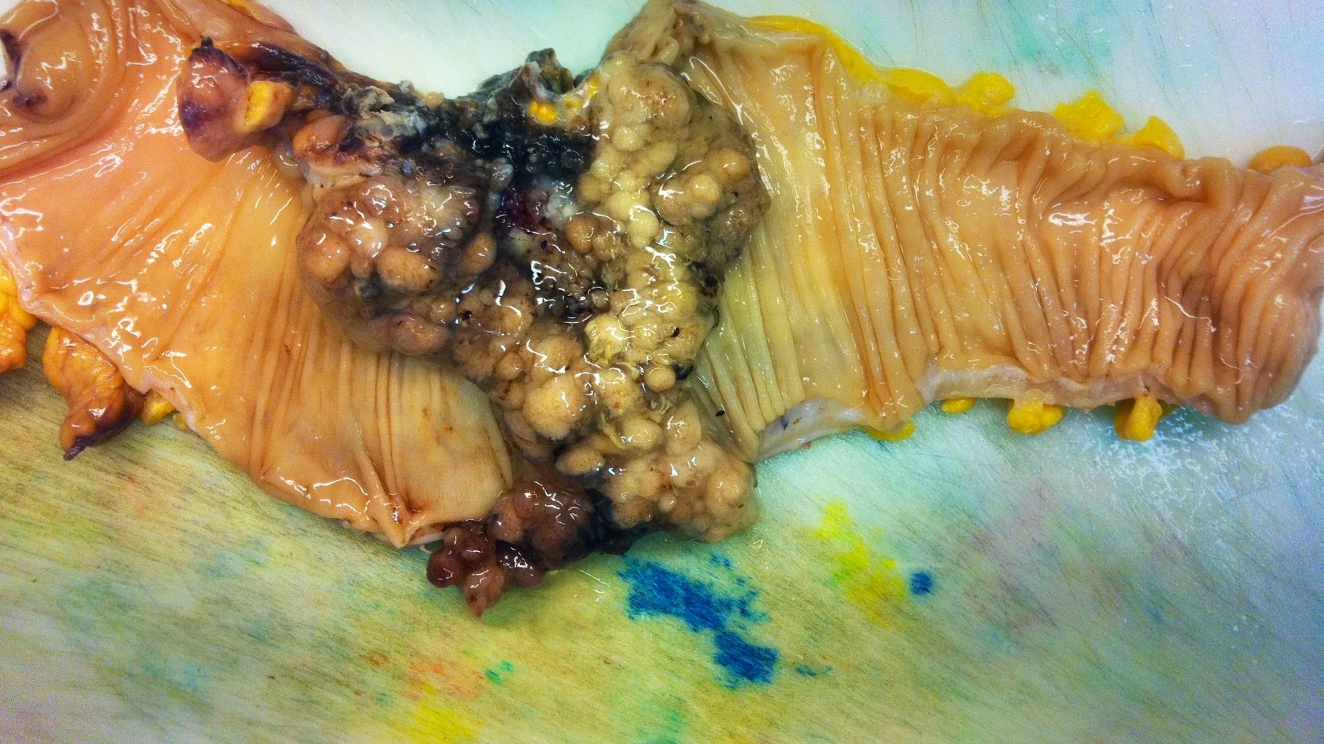 cancerous tumor on a colon