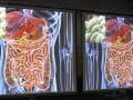 Cómo convertirse en un superdonante de trasplante fecal