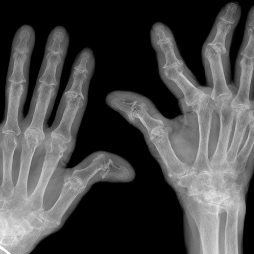 Rheumatoid Arthritis