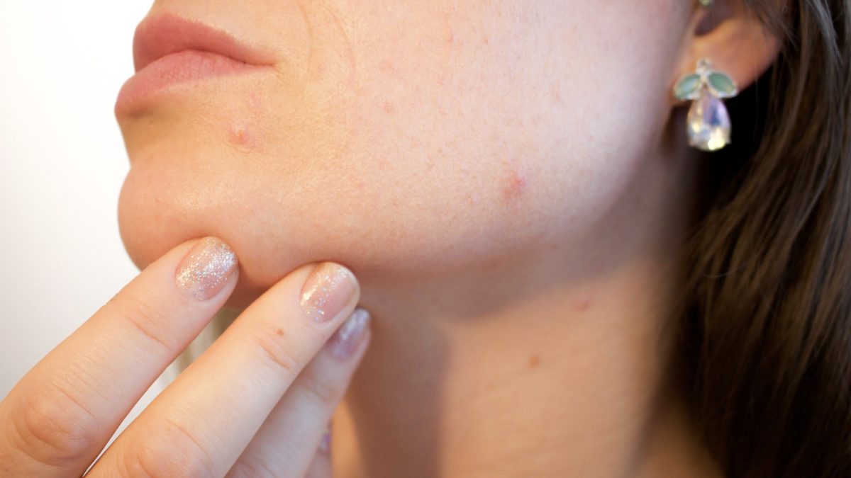 close up of person's jaw with acne