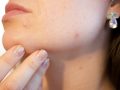 close up of person's jaw with acne