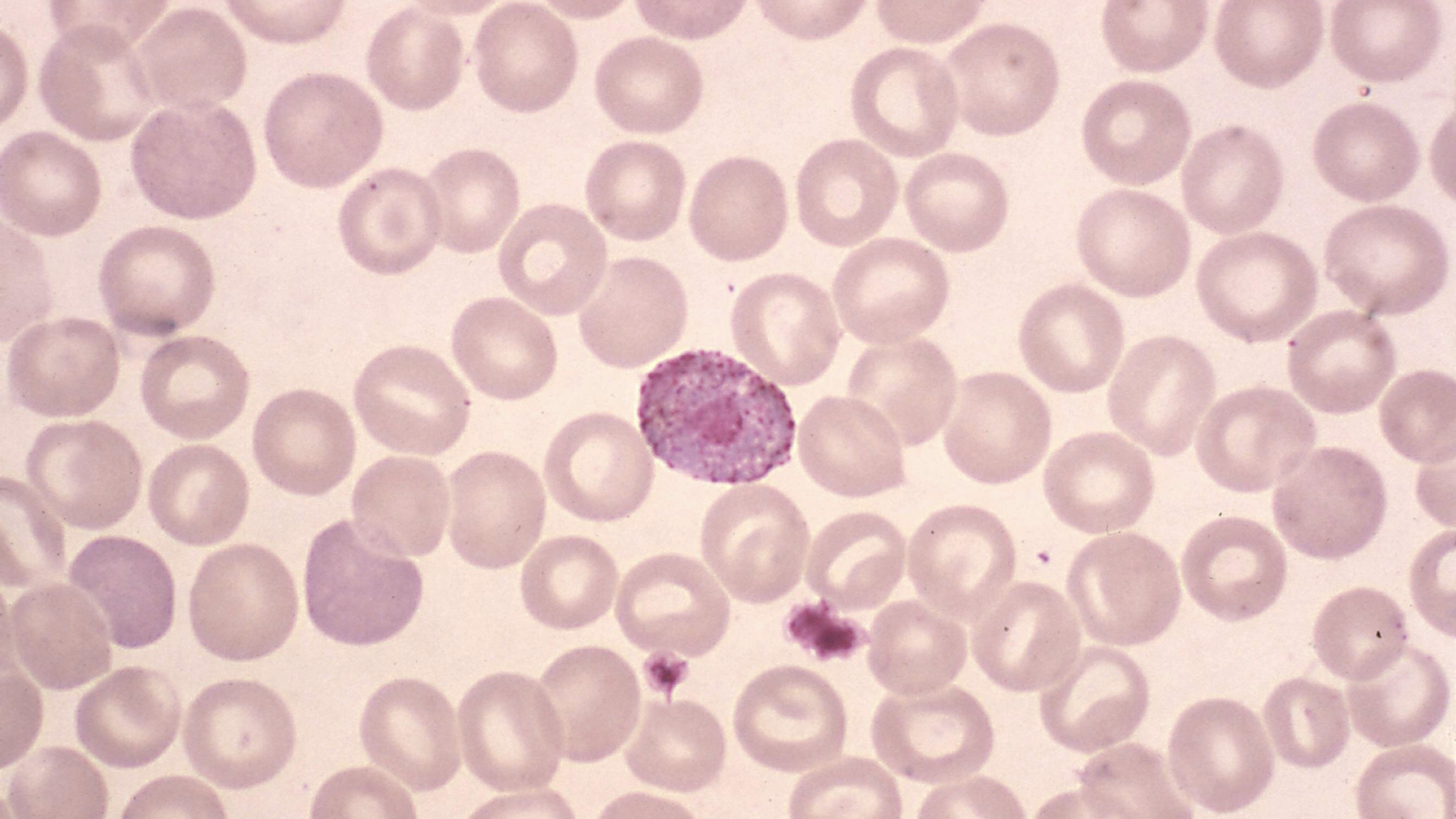 klow white blood cell count Tutorial  The Project Low White Blood Cell Count