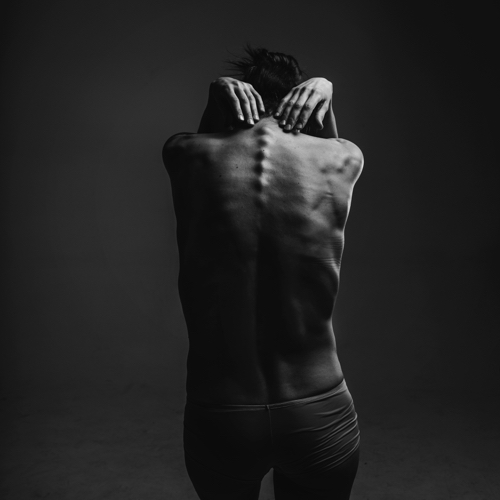 Esclerosis Múltiple
