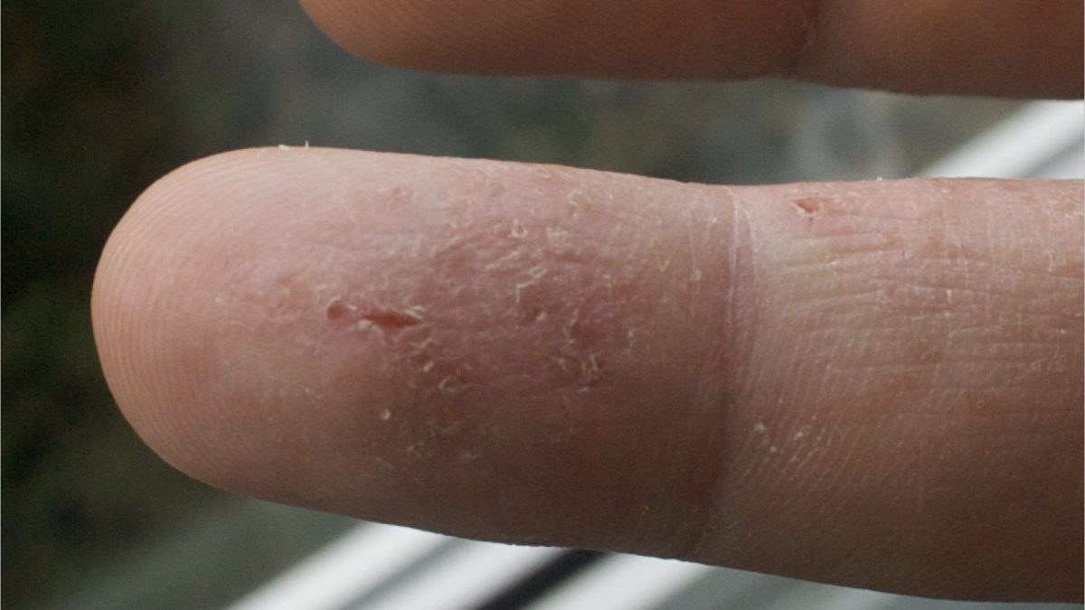 close-up of a person's finger with eczema