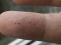 close-up of a person's finger with eczema