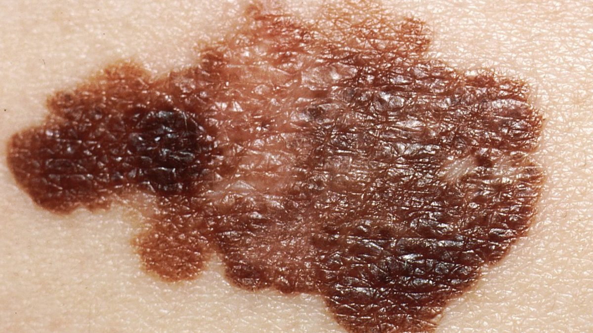 close-up of skin cancer