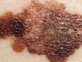 close-up of skin cancer