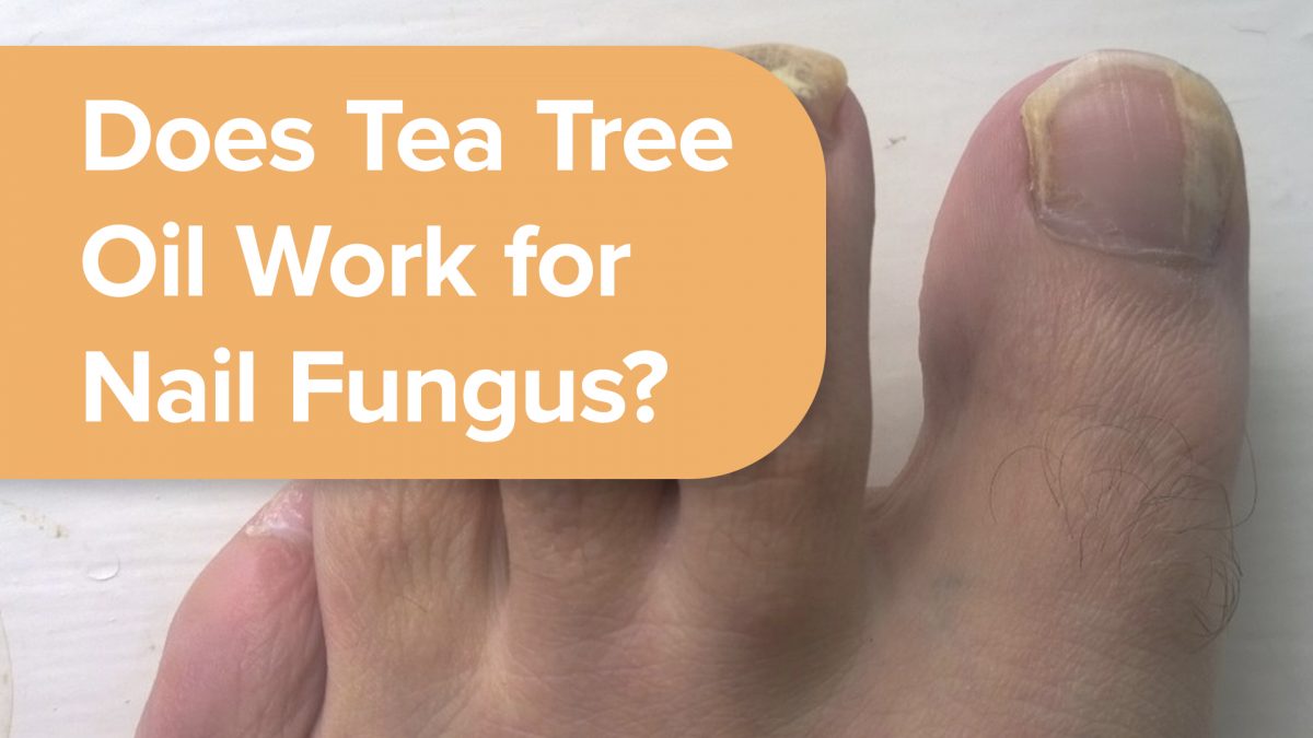 toenails with fungal infection