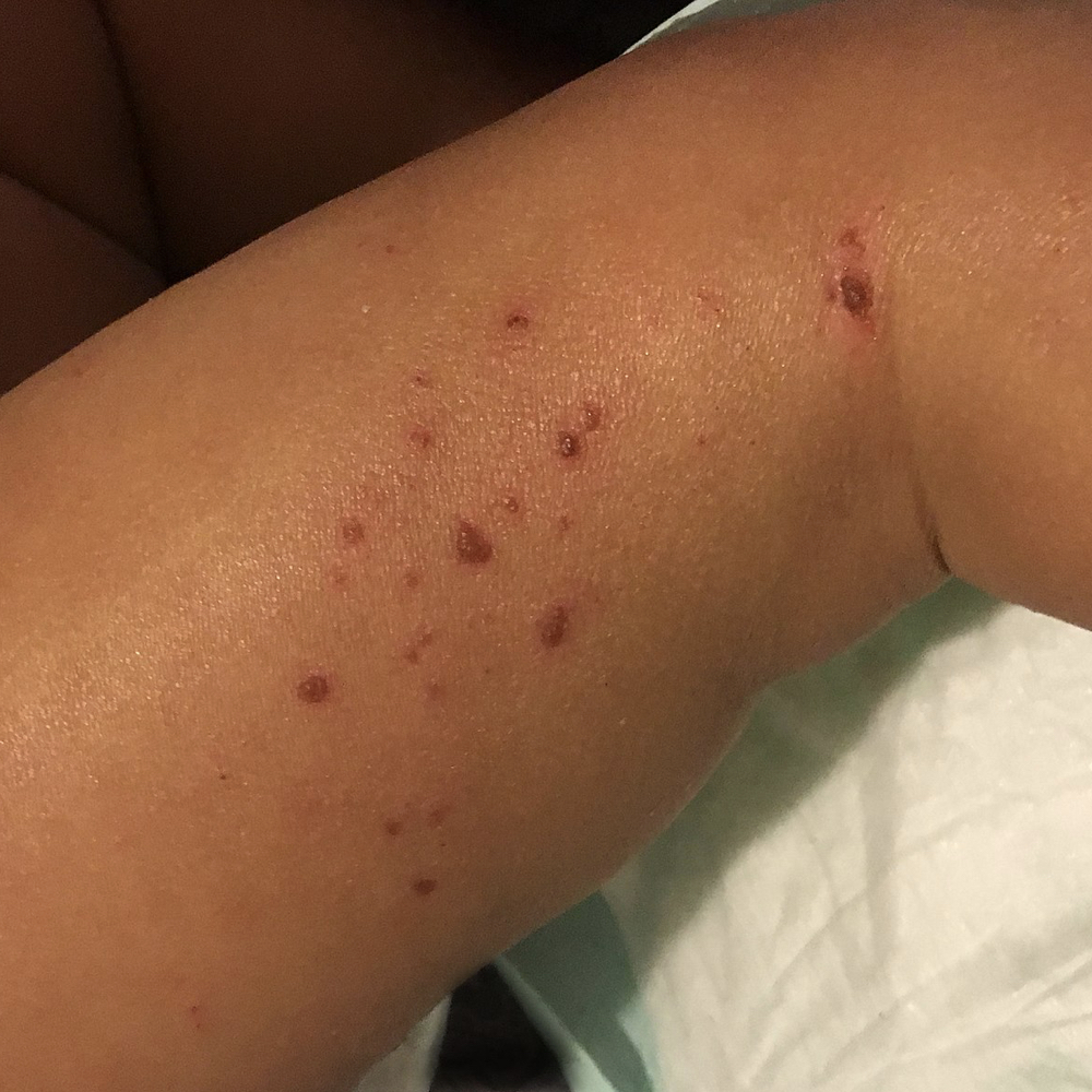Eccema