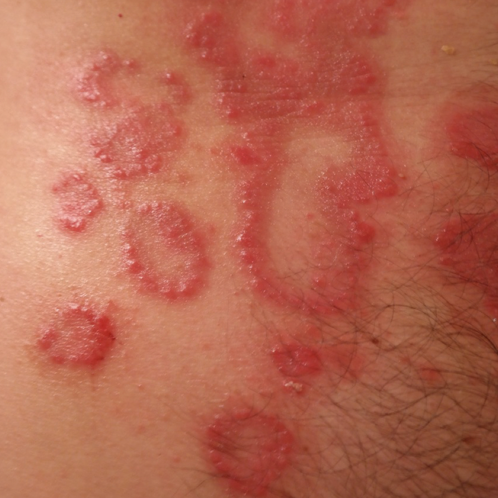 Psoriasis